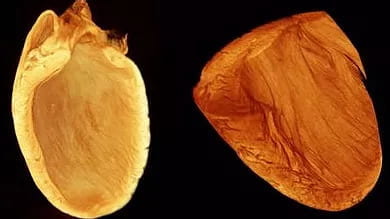 Multidimensional CT images of a mouse model of dilated cardiomyopathy demonstrating chamber enlargement and fiber reorganization.